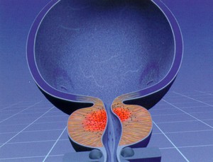 Аденома простаты